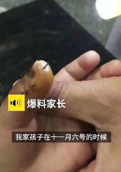 残忍！安徽歙县一幼教摔打男童致手指骨折！