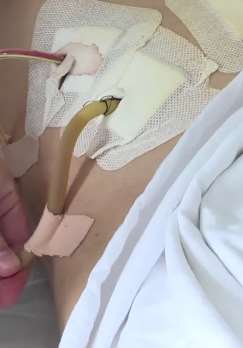 江苏一男子因工作压力情绪波动大导致胃穿孔