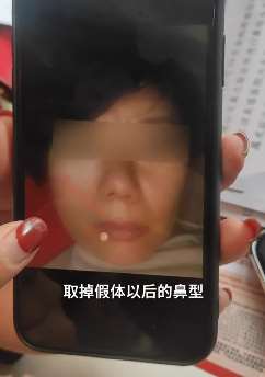 兰州一女子隆鼻后鼻孔不对称，因涉事机构老板换人不予解决