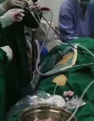 广东一男子体内取出上千个结石令人吃惊