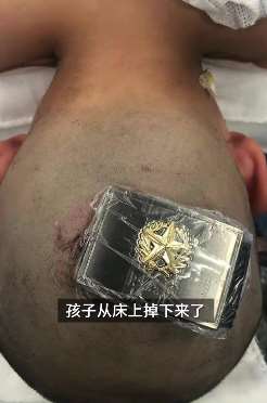 看着都疼！女童从床上摔下皮带扣扎进后脑