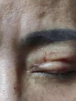 女子割双眼皮后伤口化脓，半年后变成三角眼