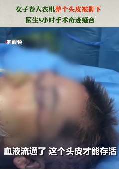 沈阳一女子头发卷入农机整个头皮被撕下