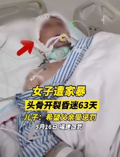 女子遭家暴头骨开裂昏迷数月