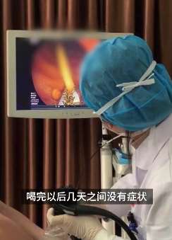 辽宁一男子啤酒不慎吞入7cm牙签卡肠子上