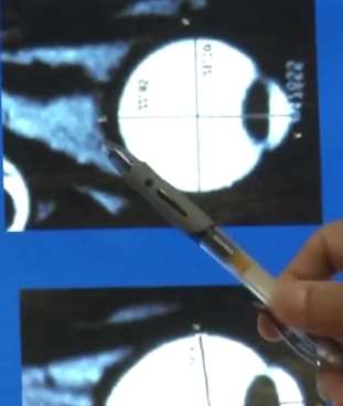 广东一女生熬夜打游戏追剧致视网膜脱落