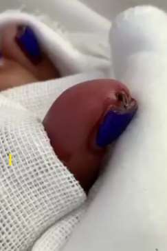 兰州一女大学生操场玩耍时右手中指被扯断