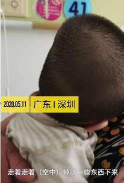 高空坠物砸中宝宝头部变形 警方上门排查无人承认