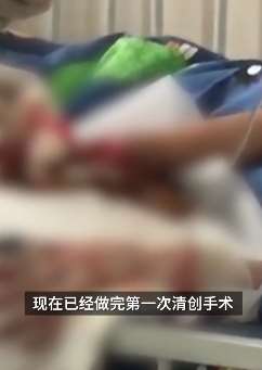 7岁男孩遭家暴双手被父亲严重烧伤