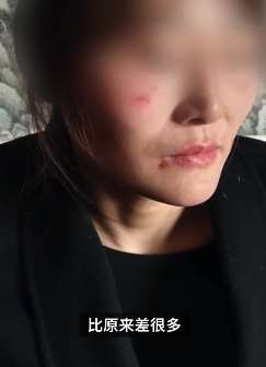 兰州一女子用完化妆品后脸部红肿溃烂，多次找店方退货遭拒