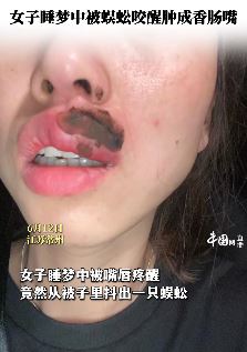 常州一女子睡觉时被蜈蚣咬到嘴唇秒变香肠嘴