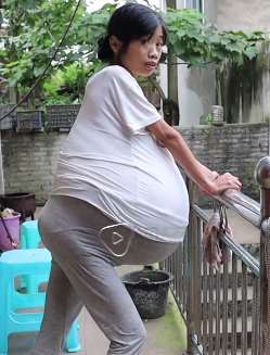 贵州一女子患怪病 肚子不断长大如健身弹力球