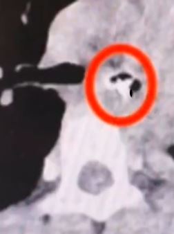 小学生连续咳嗽发烧8天 医生检查发现气管内有个铅笔帽