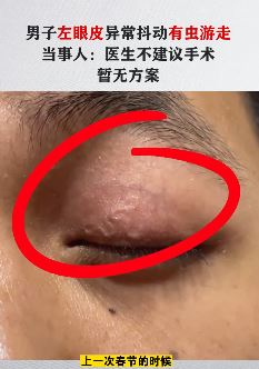 郑州一男子左眼皮发现虫子游走 看过省内多家束手无策