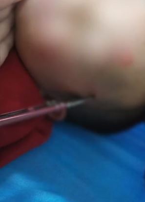 安徽一2岁男童玩耍时不慎摔倒 手中剪刀插入颅内