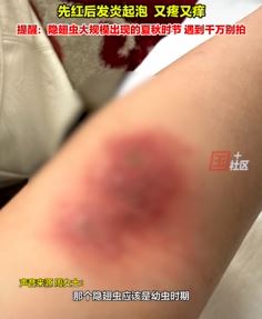 女子胳膊被隐翅虫咬中毒半月未愈