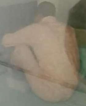 21岁女大学生突发白血病 父亲为其做骨髓移植