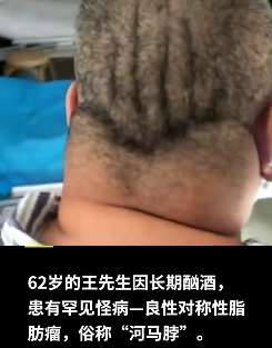 辽宁一男子长期酗酒患罕见怪病“河马脖”