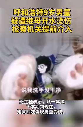 9岁男童双手疑遭继母烫伤 班主任称多次发现男童受伤
