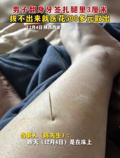 男子翻身牙签扎腿里3厘米 自己拨不出到医院取出