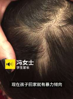 呼市多名儿童疑在幼儿园遭虐待 身上头部有不明针眼