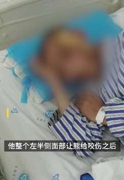 四川一男子面部被棕熊咬伤 医生用16小时为其做面部修复手术