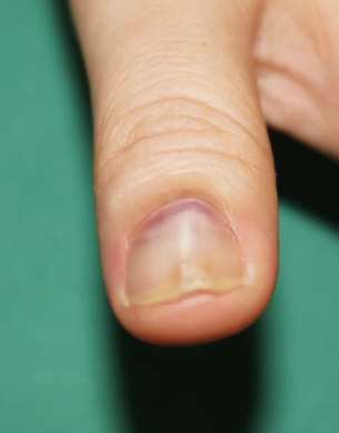 南京一女士指甲疼痛多年 检查后发现是血管球瘤在作祟