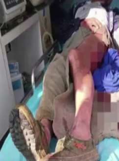 四川一村民上山找羊被黑熊咬伤惊险逃生