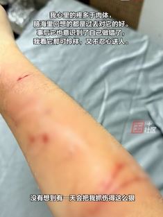 广州一女子称被爱猫抓咬致20多处伤口，心痛大于伤痛