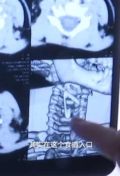 南昌一男童误吞别针卡在食道 手术后成功取出