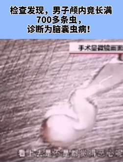 浙江一男子头晕抽搐就医 医生：脑子进虫！