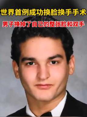 世界首例换脸手术成功，男子车祸后换掉整张脸