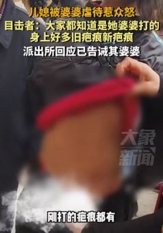 儿媳遭婆婆虐待身上留下很多疤痕惹众怒