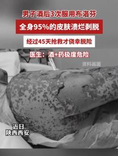 西安一男子酒后3次服用布洛芬致全身95%溃烂