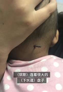 揪心！济南一男童玩耍时跌倒 井盖翘起钢筋扎颅内！