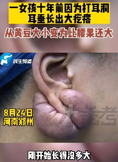 女孩打耳洞长出大疙瘩 医生：瘢痕疙瘩