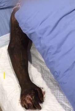 湖北一村民田里干活被毒蛇咬伤 整条手臂变黑