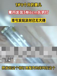 1岁婴儿胃内发现3根6cm长钢钉