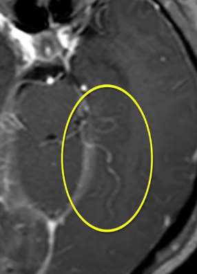 江苏一女孩脑中取出活虫 2年前曾吃过蛙类食品