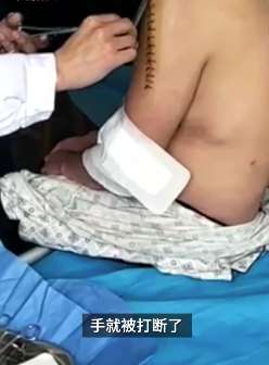 疫期男子因戴口罩被打致骨折 检察院抗诉伤人者量刑偏轻