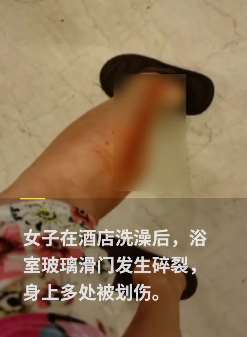 女子入住酒店洗澡后遇滑门碎裂致多处划伤