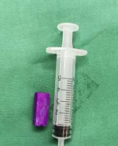 5岁女童下体塞入3cm蜡笔  医生通过手术取出