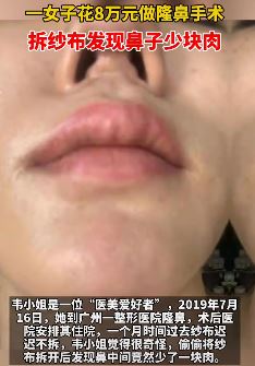 女子花8万元做隆鼻手术后少块肉