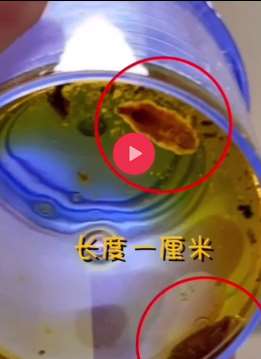 太可怕了！深圳一女子体内取出活虫！
