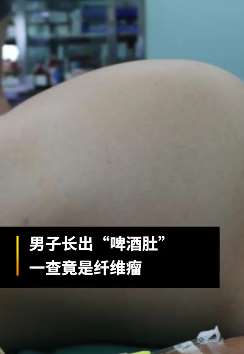 广州一男子"啤酒肚"竟是个6.4公斤肿瘤 手术切除后已康复出院