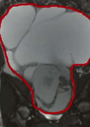 江苏一14岁女孩肚大如怀孕 到医院取出30cm卵巢肿瘤