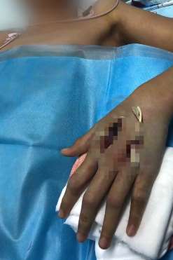 长春一男孩网购竹叶青蛇被咬后险丧命