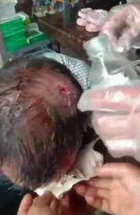 贵州玉屏突降冰雹 路人头部被砸破