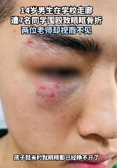 山东济宁一14岁男孩被同学围殴致眼眶骨折 老师却视而不见