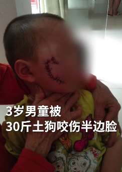 广东一3岁男童被狗咬伤脸部缝合30多针 警方正寻找狗主人